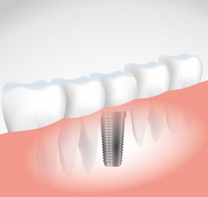 duvidas_implante_dentario
