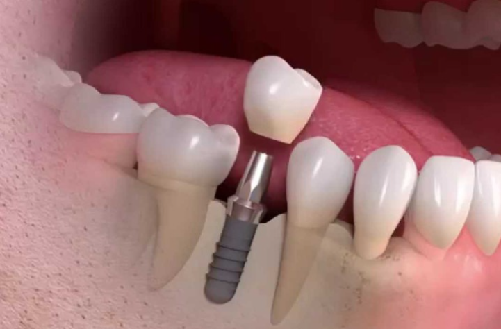 <strong>Implantes Dentários: Respondendo às suas Principais Dúvidas</strong>